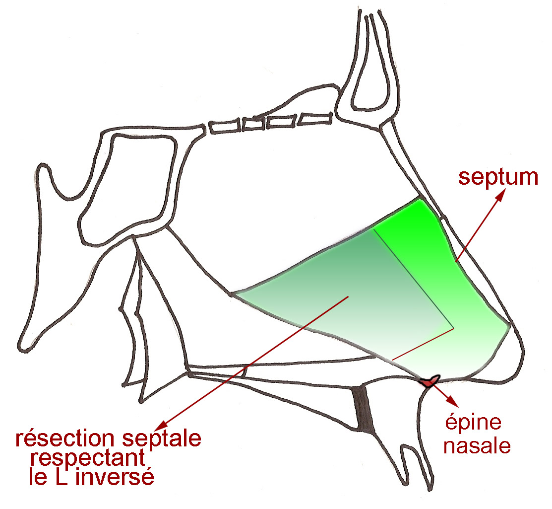 L-inverse-rhinoplastie-chirurgie-esthetique