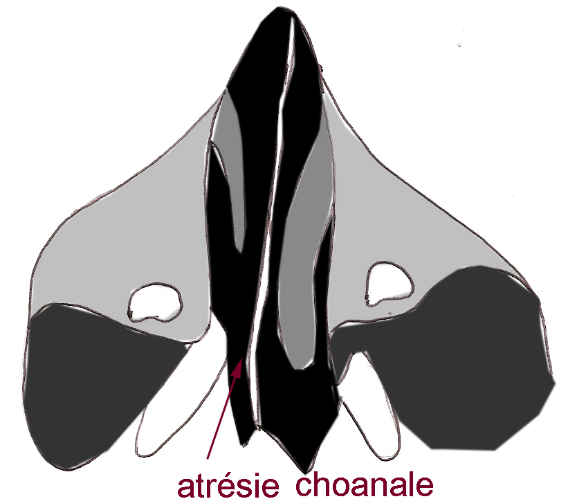 atresiechoanale-obstruction-nasale-nez-bouche