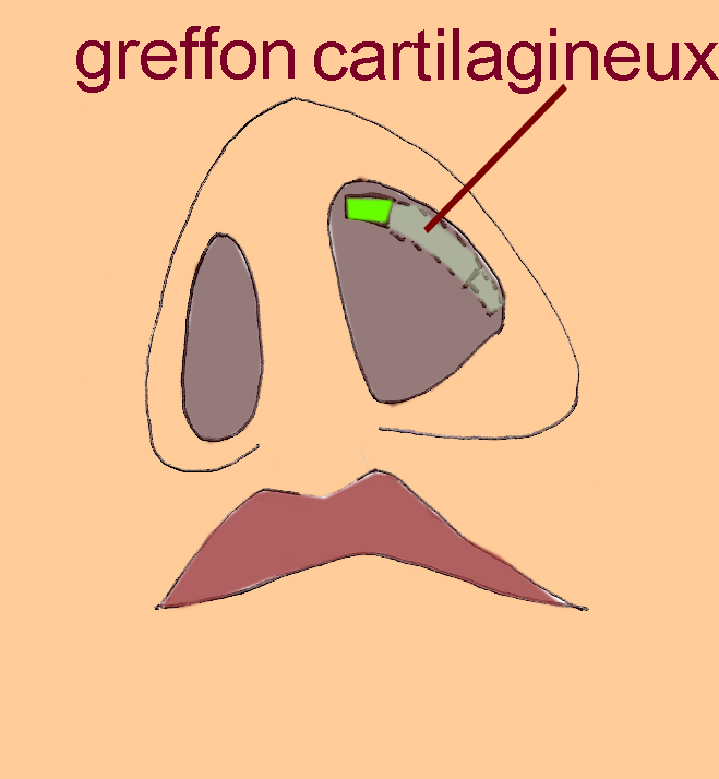 greffon-aile-narine-retractee-chirurgie-esthetique-rhinoplastie