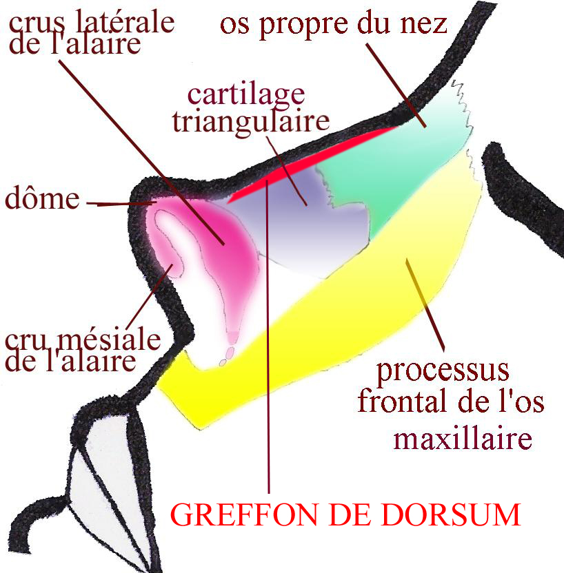 greffon-dorsum-gros-nez-chirurgie-esthetique-rhinoplastie