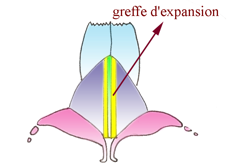 greffon-expansion-chirurgie-esthetique-rhinoplastie