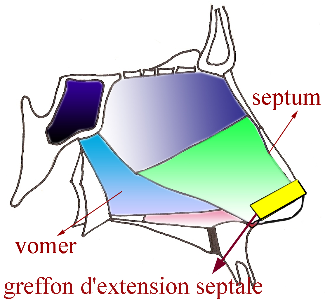 greffon-expansion-septale-chirurgie-esthetique-rhinoplastie