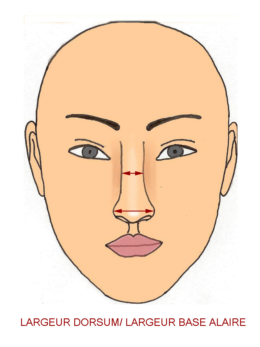 largeurdorsum-nez-gros-rhinoplastie-chirurgie-esthetique