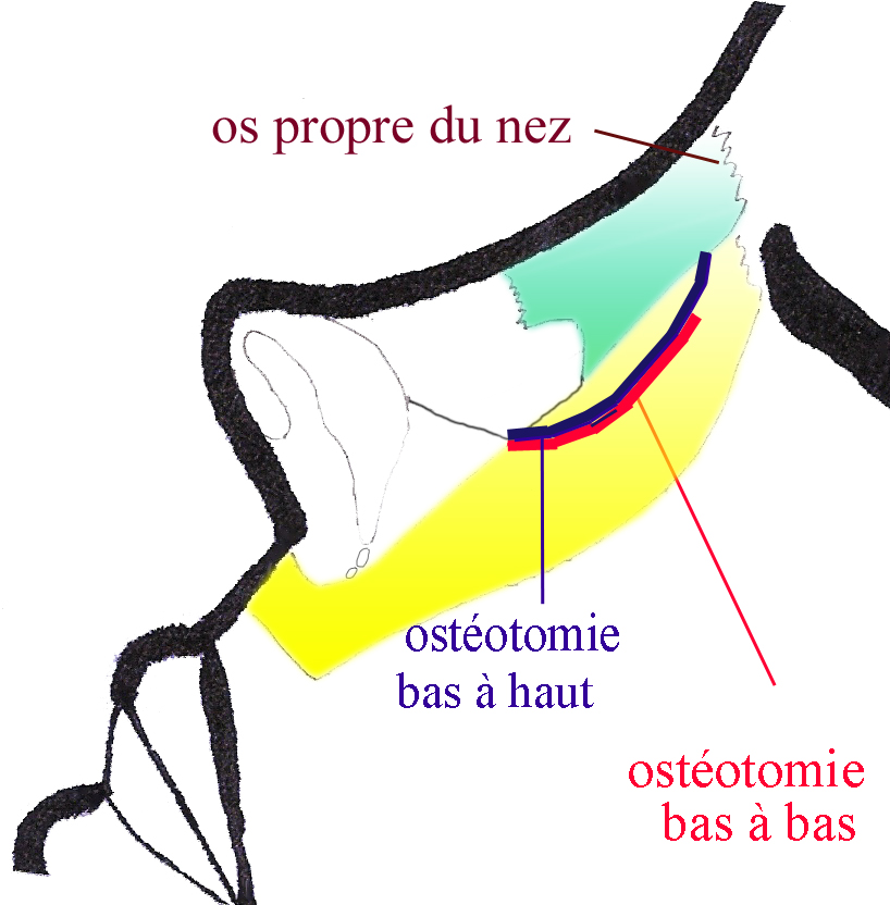 osteotomie-trajets-chirurgie-esthetique-rhinoplastie