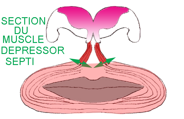 section-muscle-depressor-septi-chirurgie-esthetique