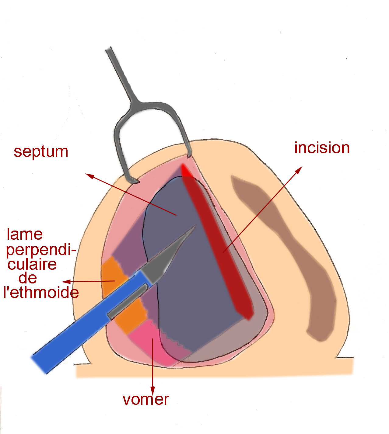 septoplastie-chirurgie-esthetique-rhinoplastie