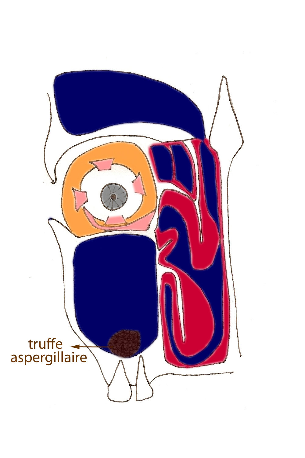 truffe-aspergillaire-sinus-rhinoplastie-chirurgie-esthetique