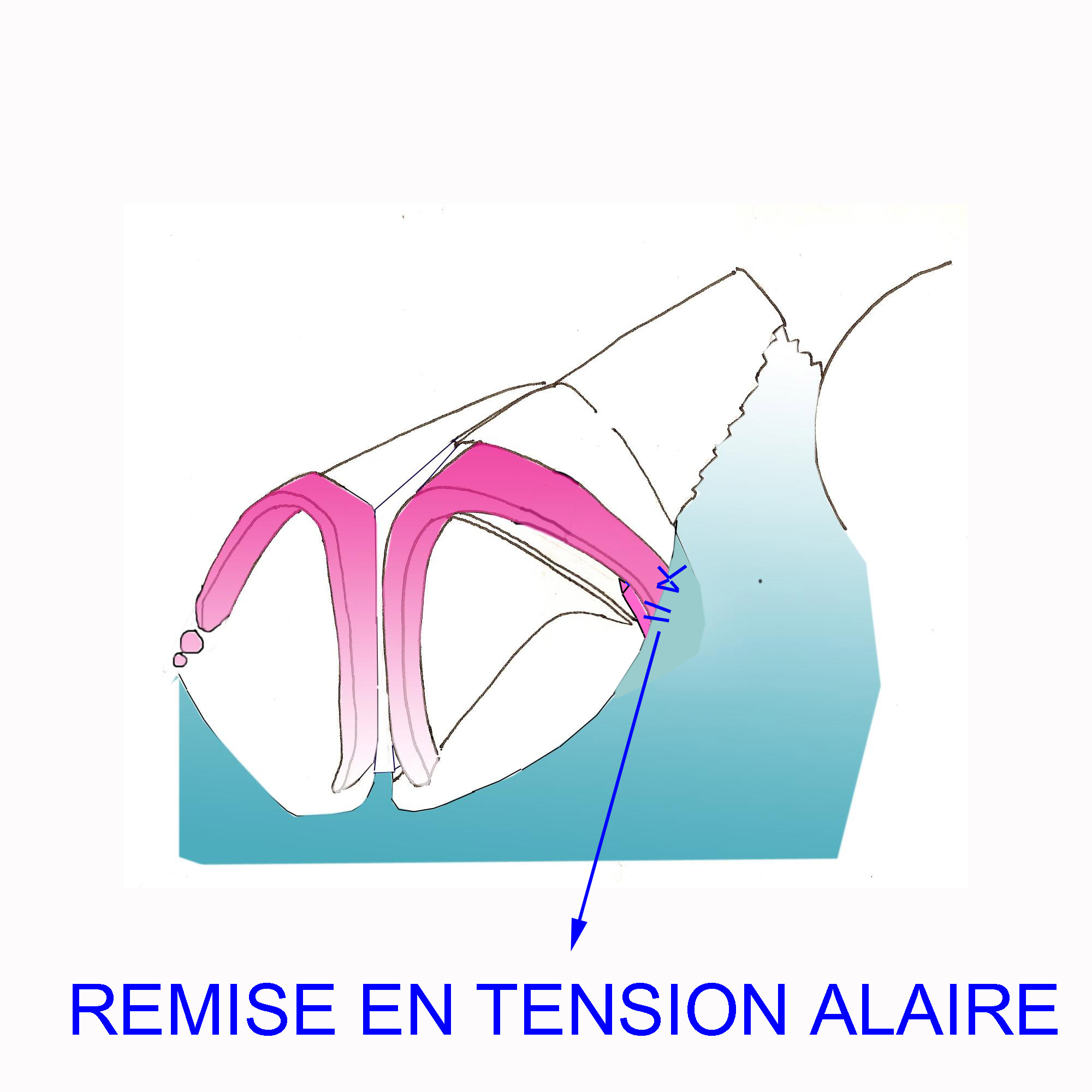 valve-externe-tension-alaire-chirurgie-esthetique-rhinoplastie